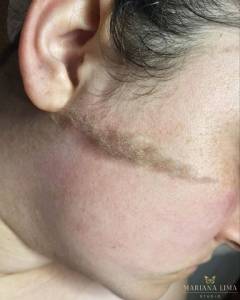 Dermaplaning