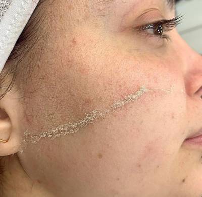 Dermaplaning Ingleses