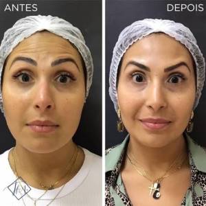 Botox Facial  Promoo Indita