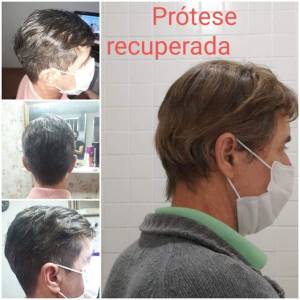 Prtese Capilar