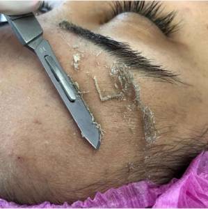 Dermaplaning Fcil