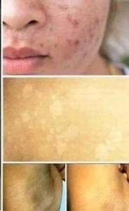 Para Acne