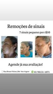 Promoo De Retirada De Sinais