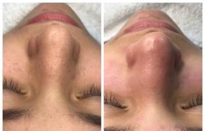 Limpeza De Pele Profunda  +peeling +vit C