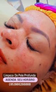 Limpeza De Pele Profunda