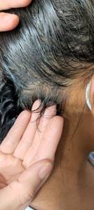 Tratamento Alopecia - Queda Capilar