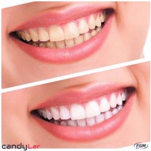 Kit De Clareamento Whiteness Perfect 22%