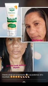 Elimina Rugas Diminui As Linhas De Expresso E Mancha De Melasma