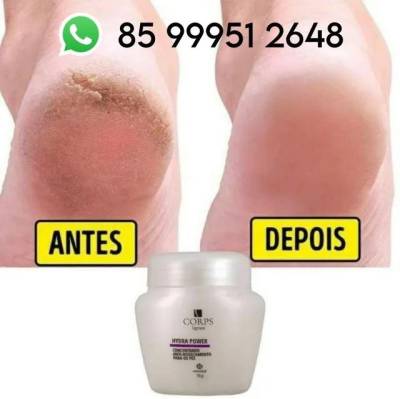 Creme Rachaduras , Ressecamento, Inchao Nos Ps