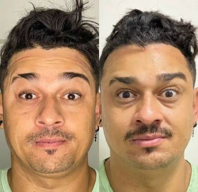 Botox Facial (at 3 reas)