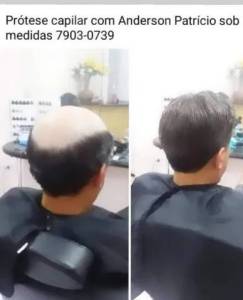 O Rei Das Prteses Capilares